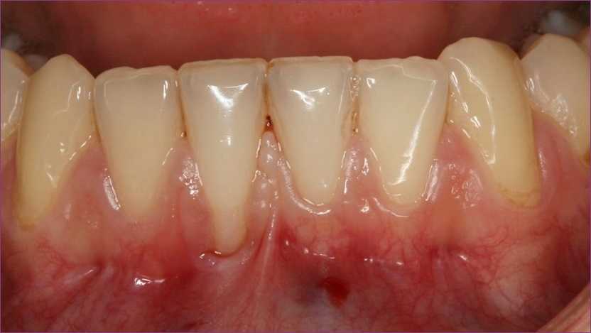 A fogágybetegség okai | origoaukcio.hu
