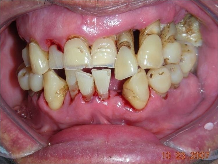 periodontitis kezelése cukorbetegeknél