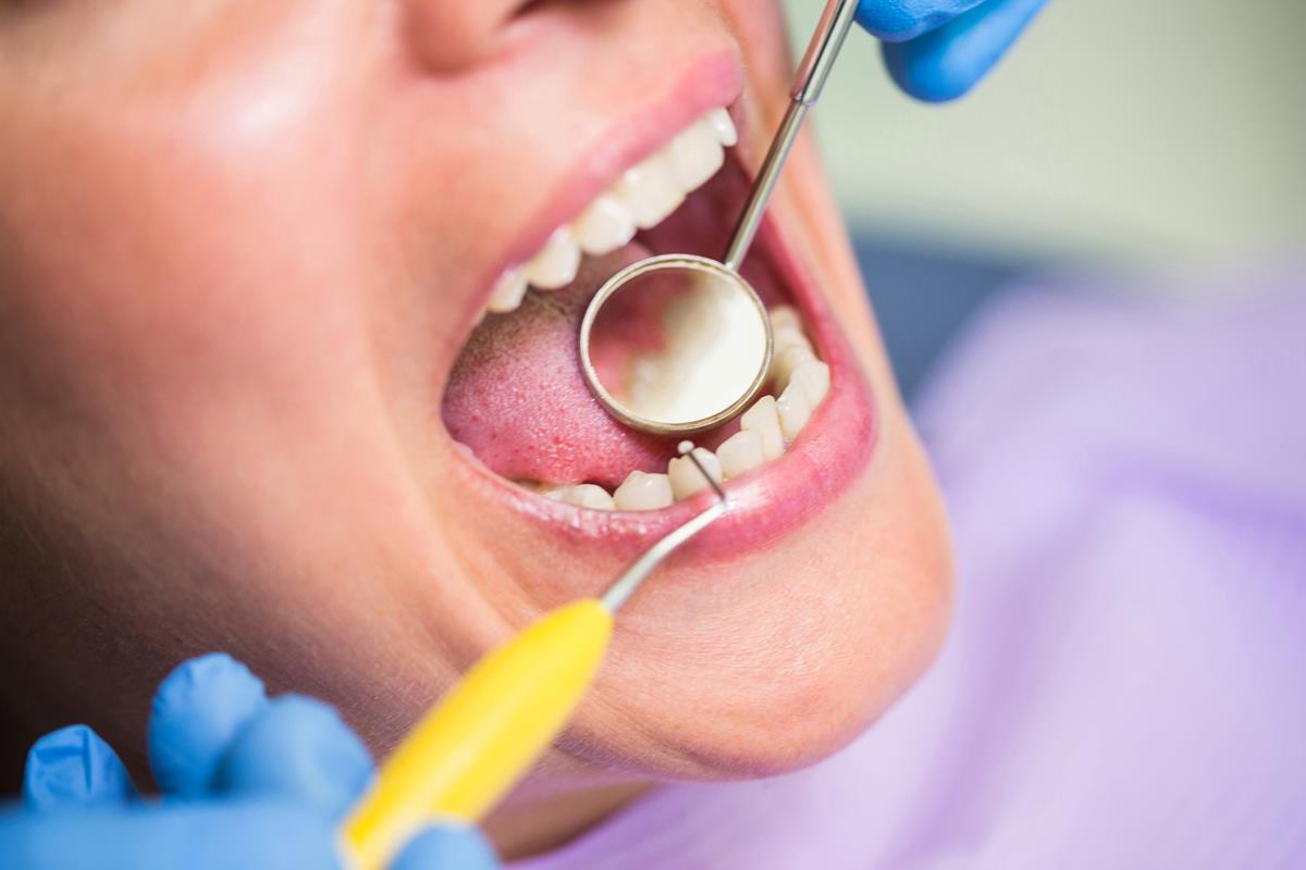 A fogkő eltávolítása kifejezetten hatékony ultrahangos fogkő eltávolítás segítségével.