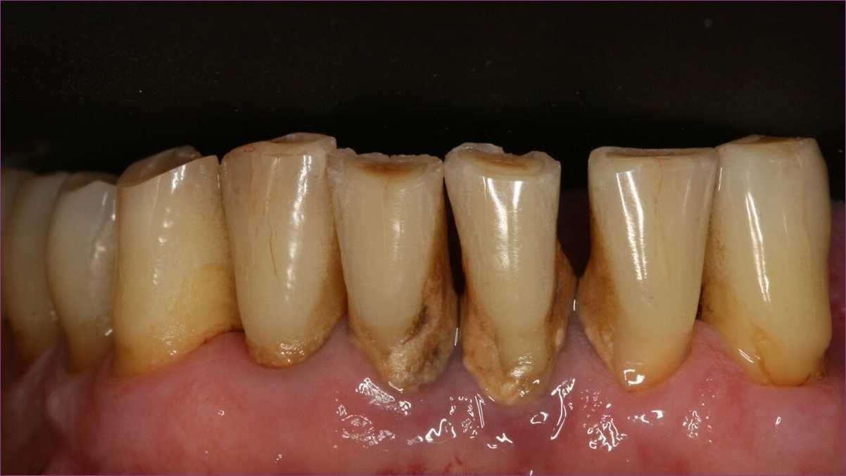 a dohányzó fogak leszokása fehérré válik