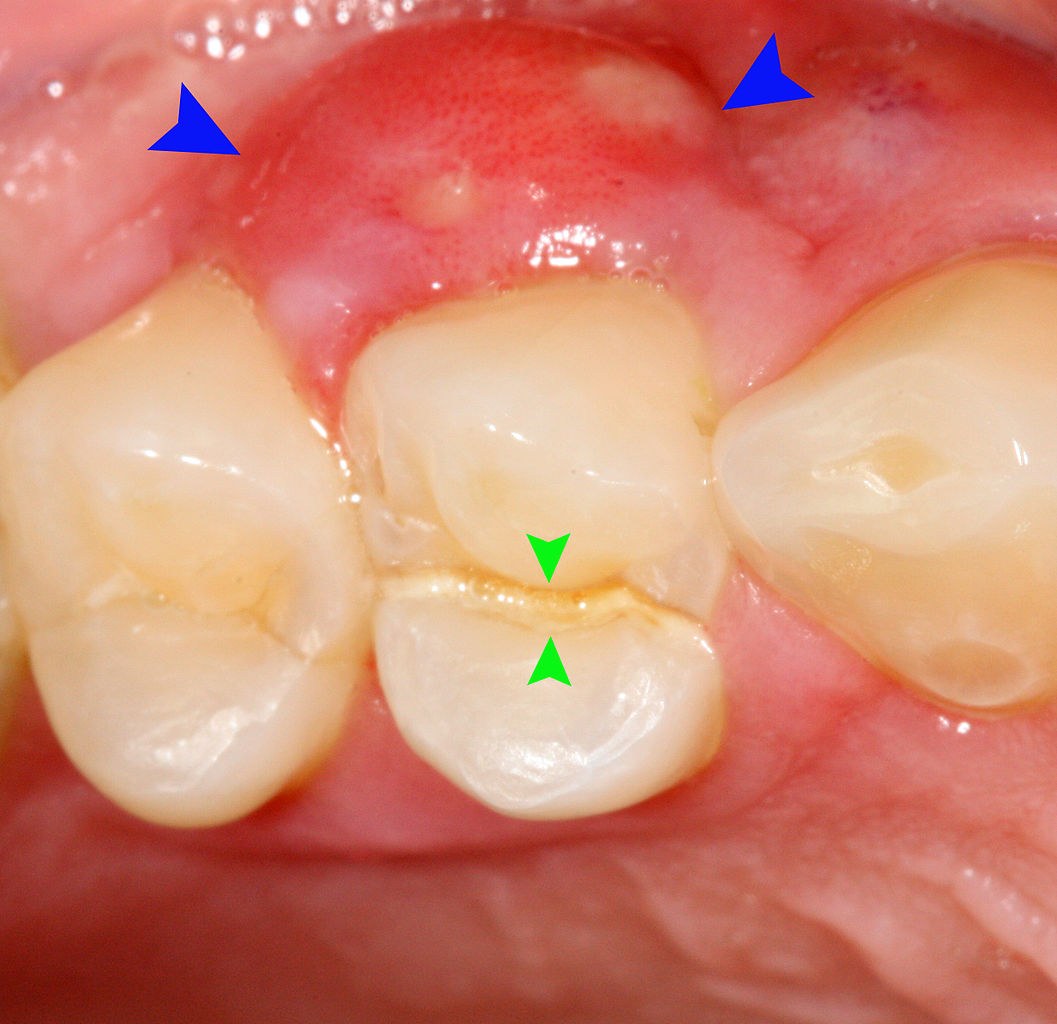 fogászati ​​betegségek képei
