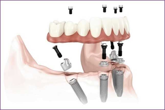 Implantációval lehet-e megoldást nyújtani a teljes foghiányra?
