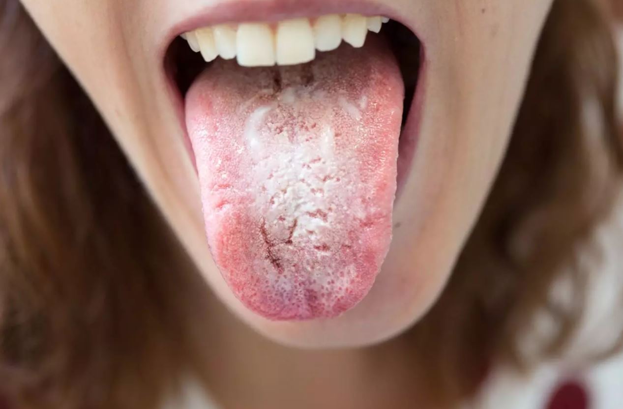 candida nyelven kezelés emberi papillomavírus hpv száj