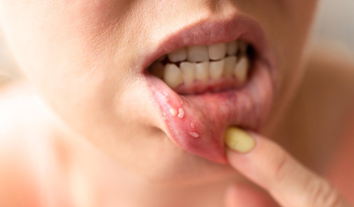 szájüregi nyálkahártya a száj aljában