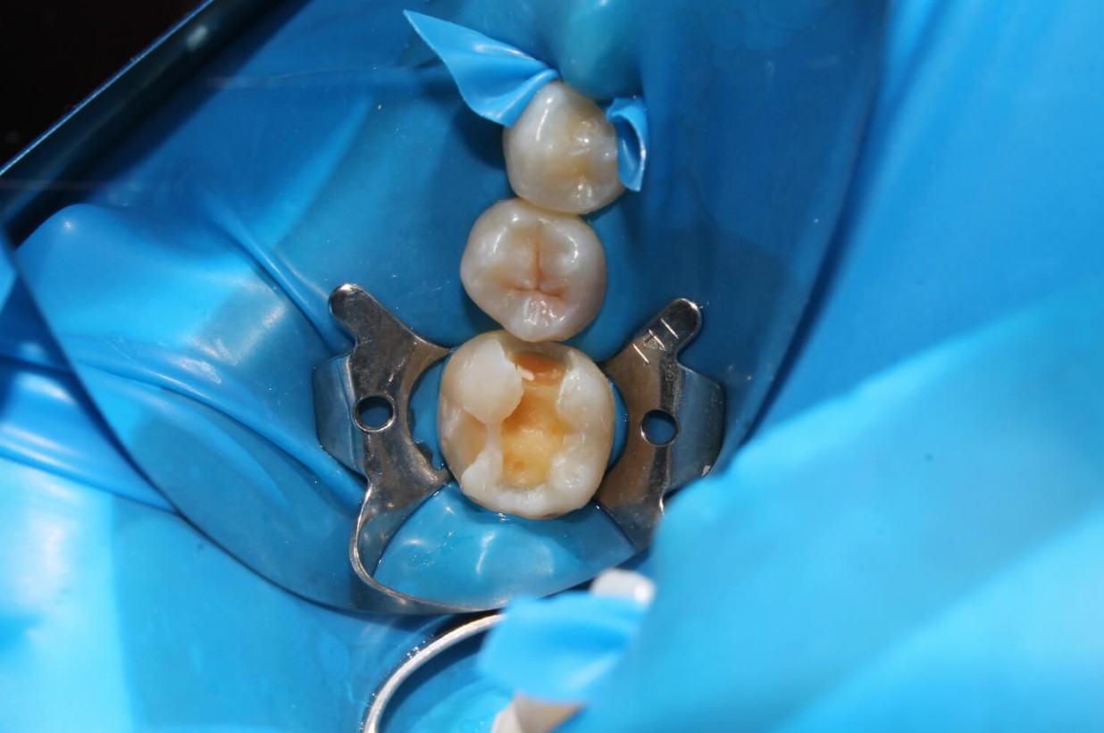 Az amalgám tömés eltávolítása: nem minden esetben szükséges.