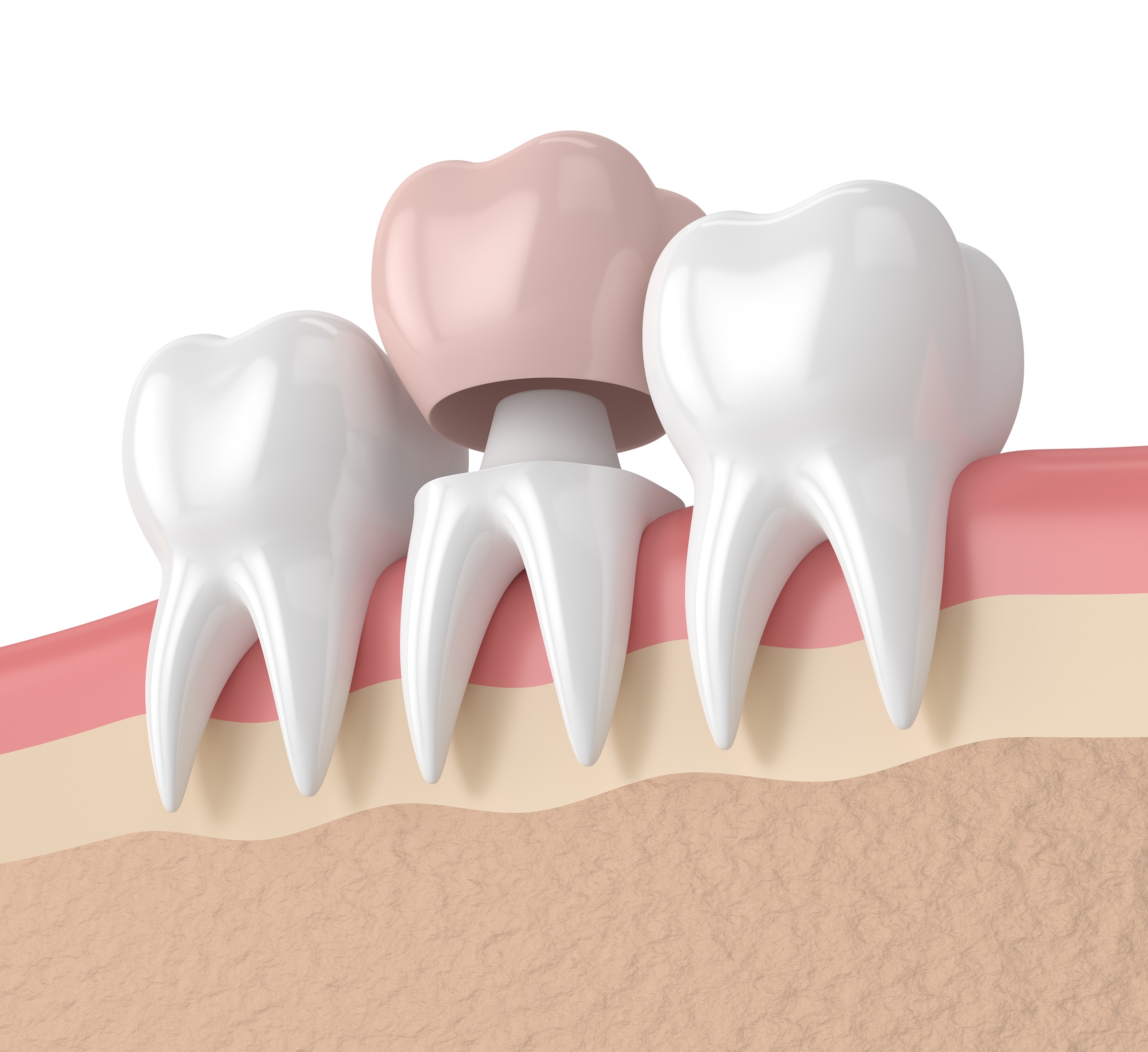 3d Render Of Teeth With Dental Crown Restoration
