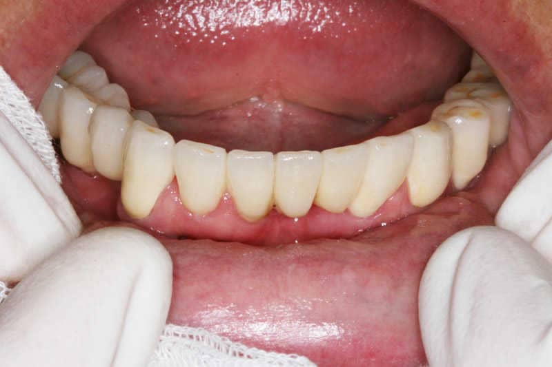 Az alsó fogsor rehabilitációjához két nobelactive implantátum behelyezését végeztük el a jobb oldalsó régióban.