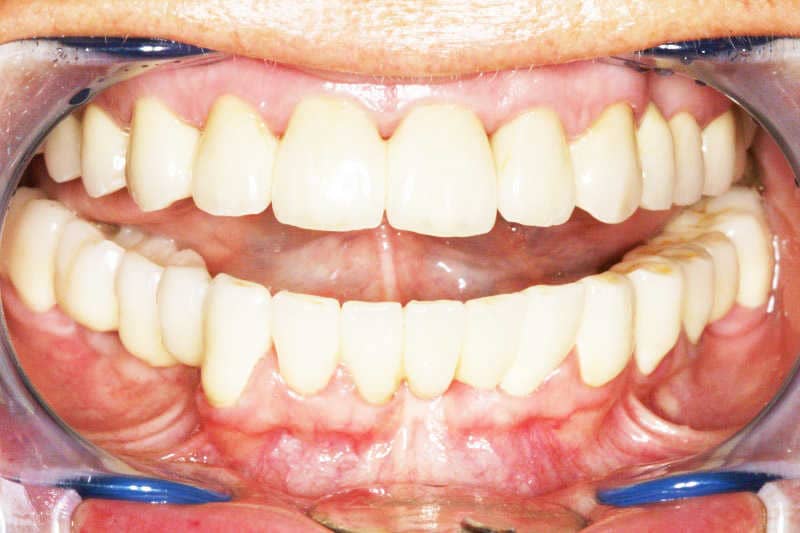  páciensünk boldogan fogadta egészséges és megújult fogsorát.