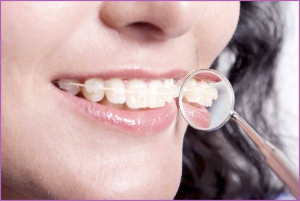 Esztétikai fogászati kezelés fogszabályozással