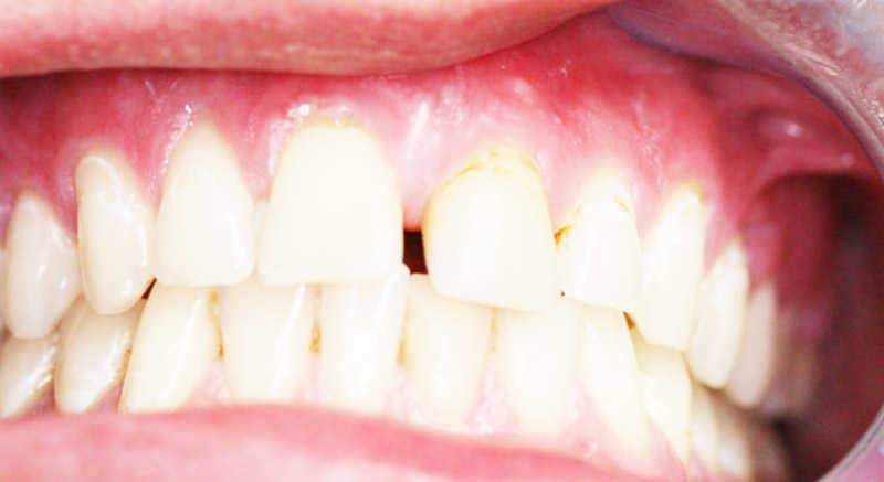  jól látható a páciens elülső fogain az elszíneződött zománc és a két nagymetsző közötti hézag diasthema.