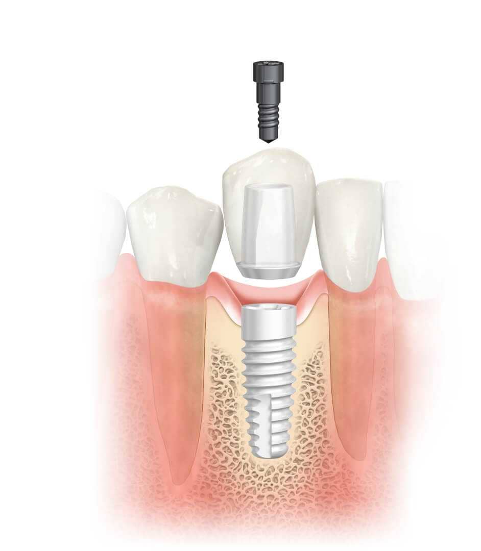 A fogimplantátum részei