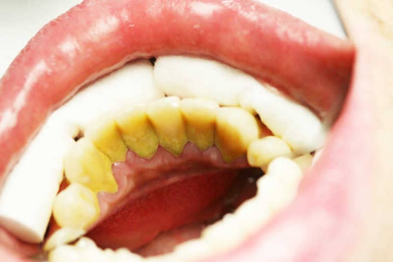 Az alsó frontfogak nyelv felőli felszínén jelentős mennyiségű fogkő és ennek következtében kialakult krónikus ínygyulladás látható