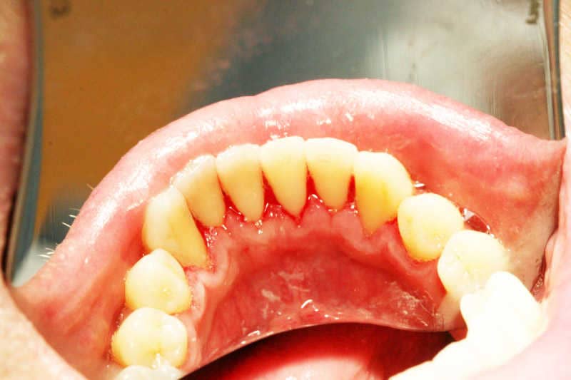 A fogkő eltávolítást követően a fogak nyelv felőli felszíne. jól láthatóvá váltak a fogak.