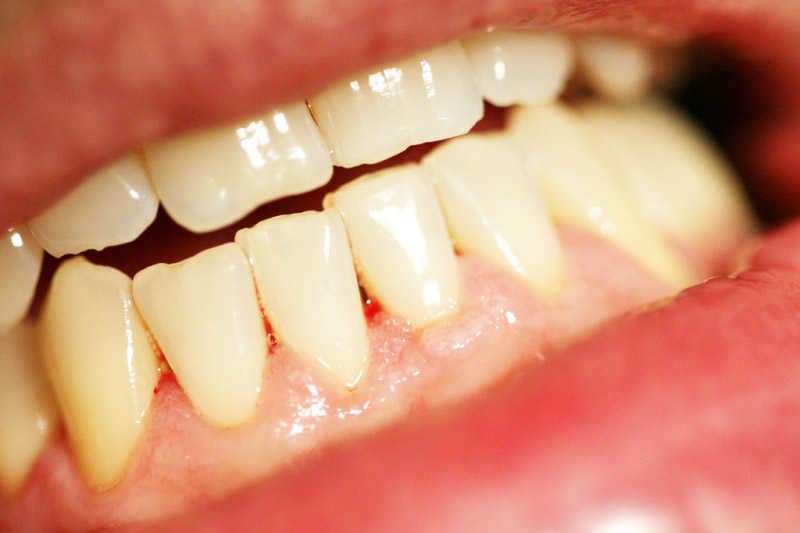A fogkő eltávolítást követően a fogak ajak felőli felszíne.