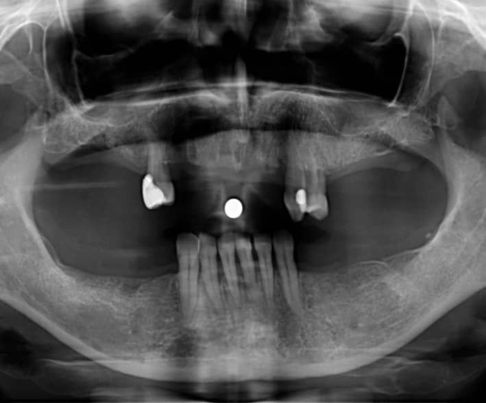  kapcsos részleges lemezes fogpótlás röntgenfelvétel