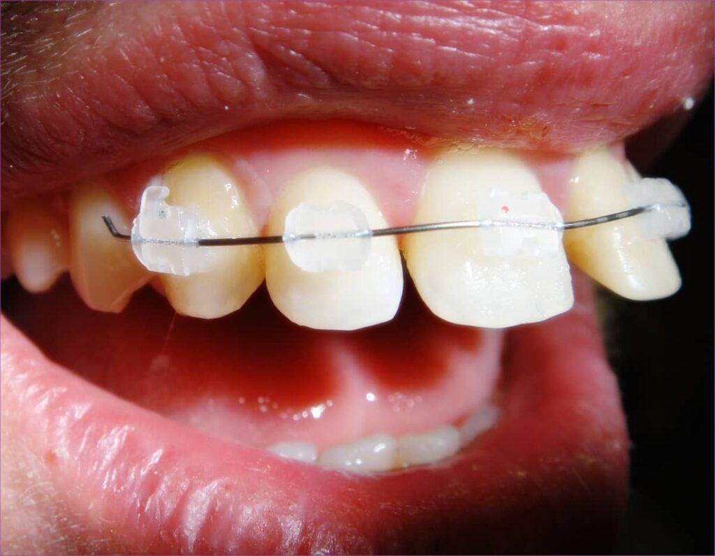 Fogszabályozás segített az előredőlő fogakon