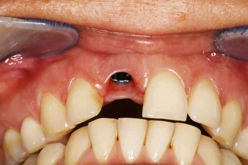  páciensünk nagymetsző fogának hiányát nobel replace implantátummal pótoljuk