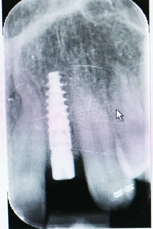 A rögzített fogszabályozó készülék levétele utáni állapot