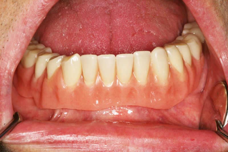 A fogsor az implantátumokra való felhelyezés után