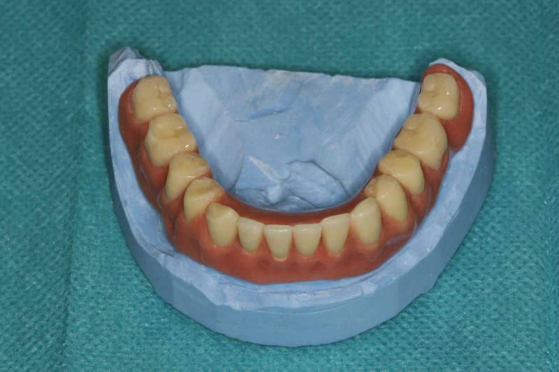 Az új fogsor rágófelszíni része