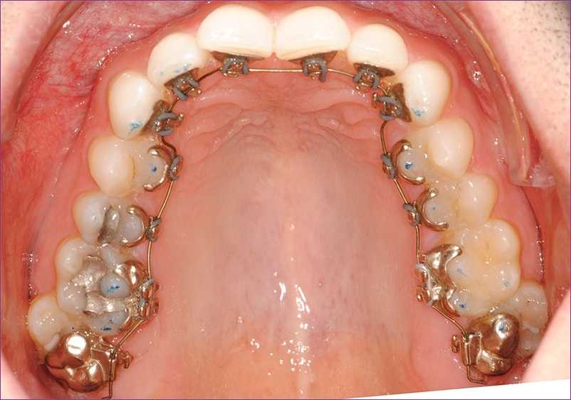  láthatatlan fogszabályozás: belső fogívre rögzített készülék