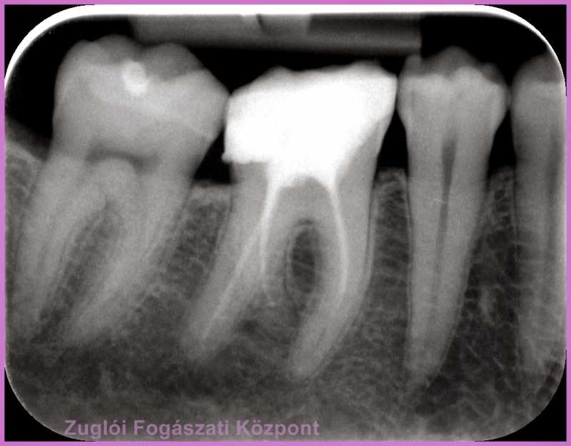  röntgen alapján gyökér kezelni kellett a fogat