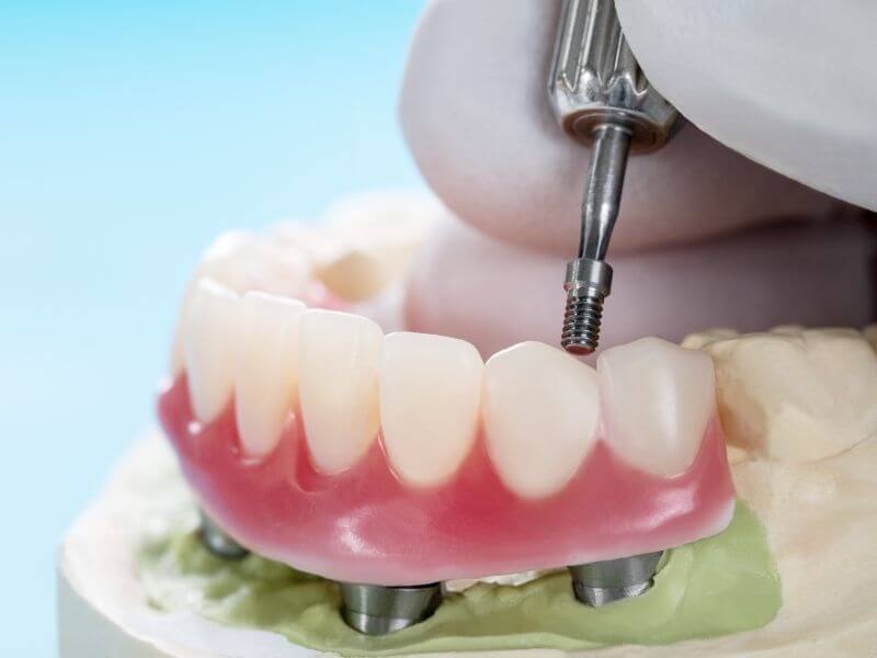 A kivehető fogsor rögzítése különféle módokon történhet.