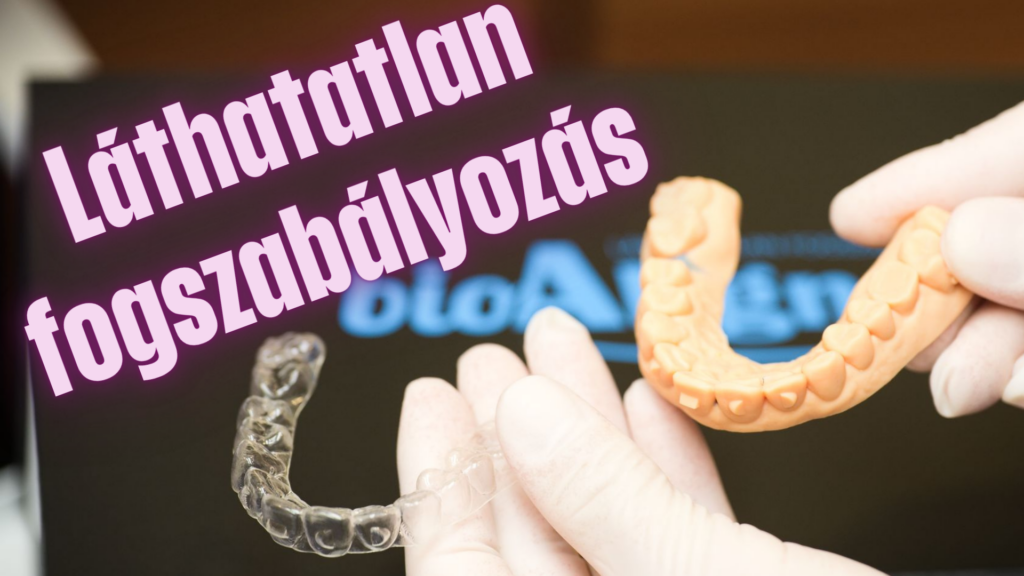 Láthatatlan Fogszabi. Index