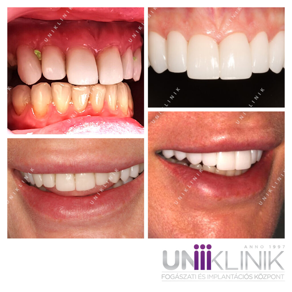 Komplex Fogászati Rehabilitáció Monolitikus Cirkon Szólókoronákkal