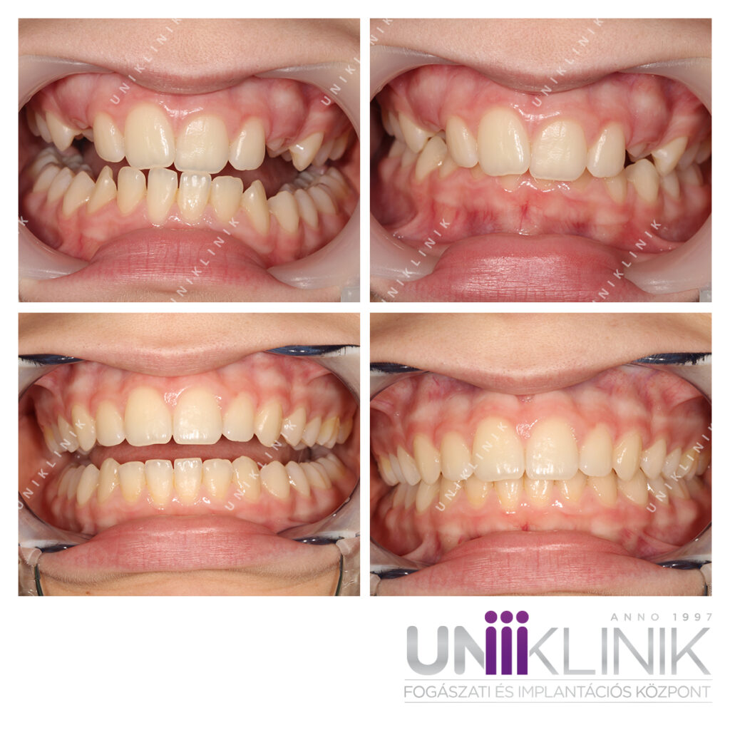 Befelé Dőlt Metszőfogak