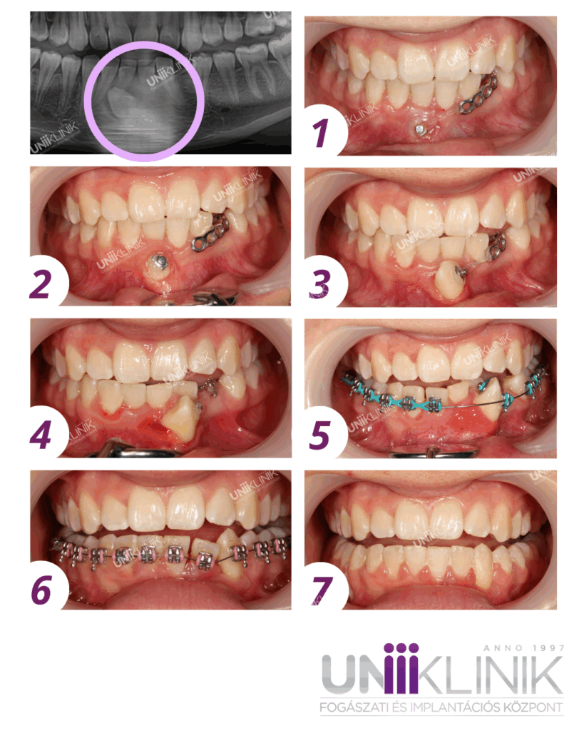 Ektópiás Szemfog Fogszabályozása