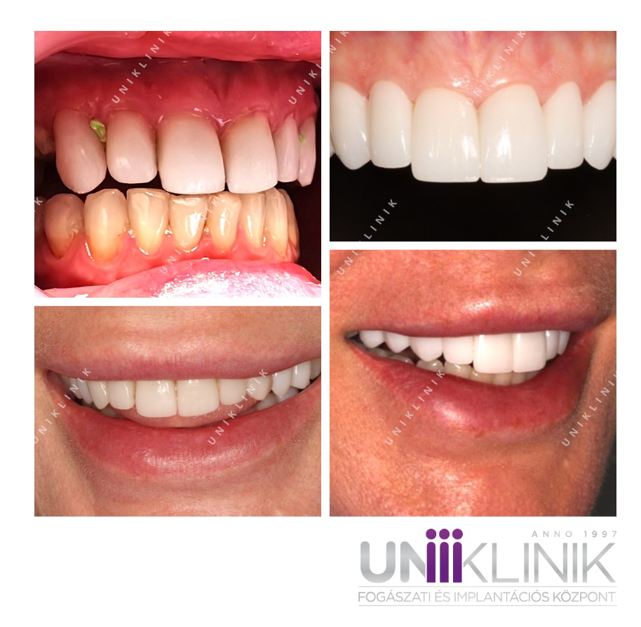 képek a direkt héj kezelés előtt és után