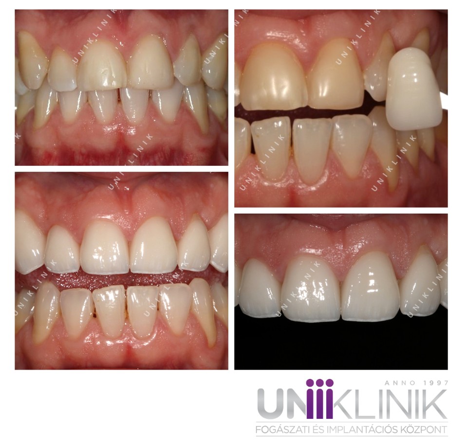 a direkt héj hátrányai közé nem sok tulajdonsága tartozik