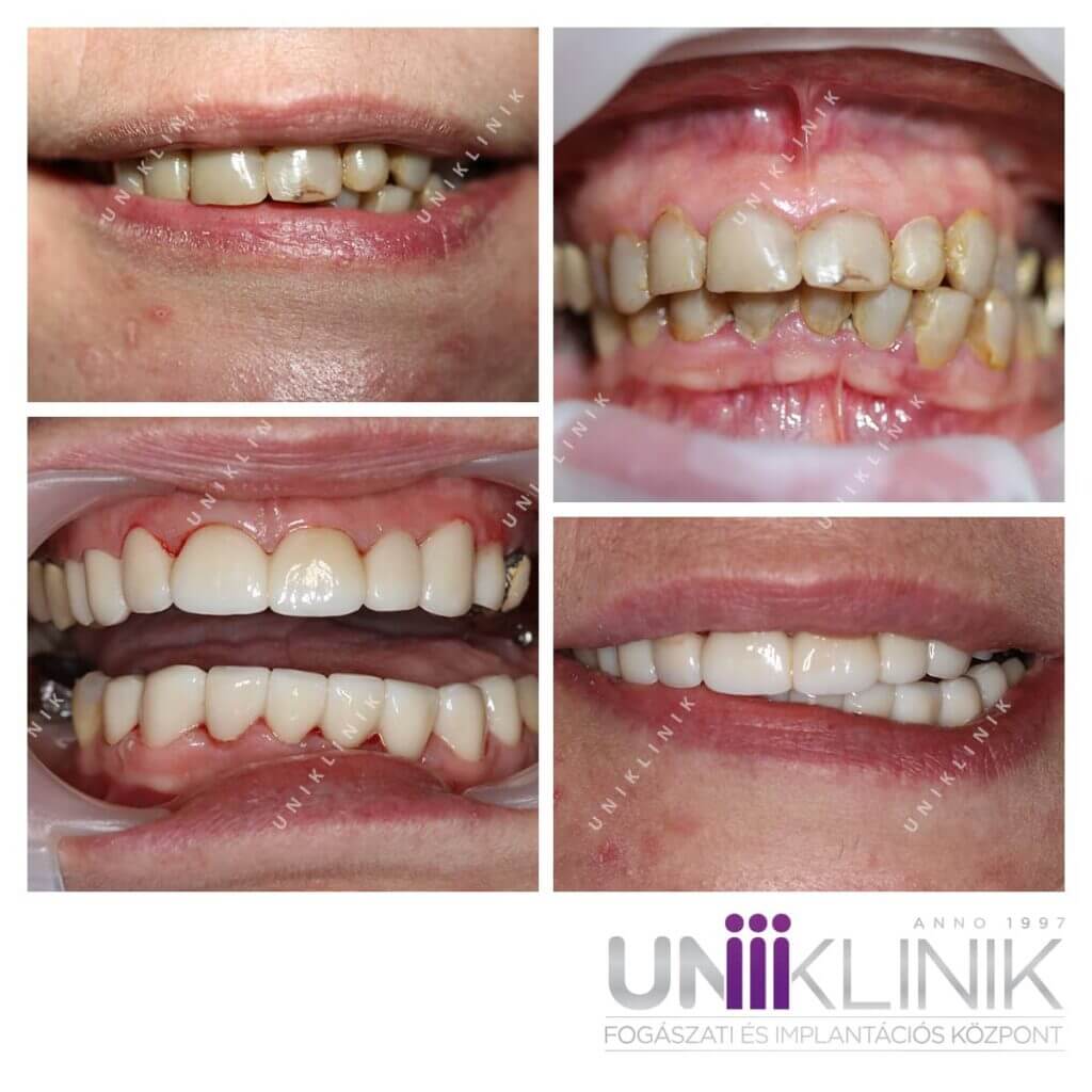 Full cirkon korona: más néven full kontúr cirkónium koronák foghiány esetén.