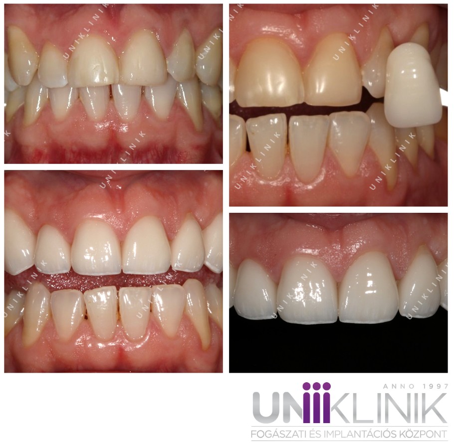 porcelán héj előtte-utána képek