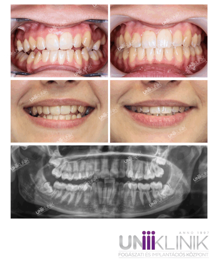 TMI Panaszos Páciens Harapásának Beállítása Fogszabályozóval